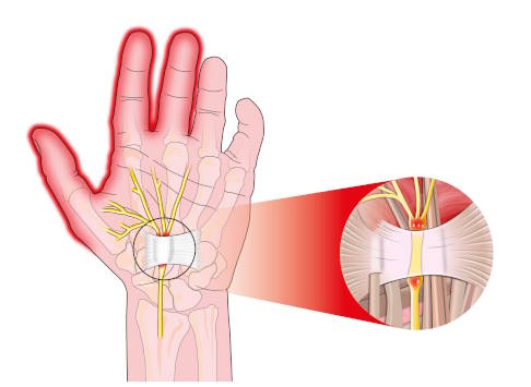 Anatomie der Hand mit Karpalband und Nervus medianus