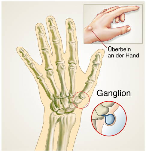 Ganglion an der Hand