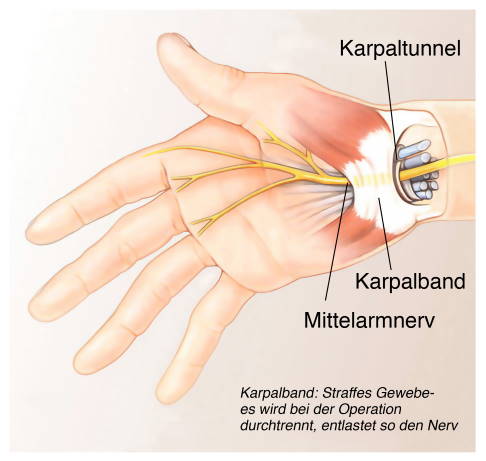 Eine häufige Erkrankung im Bereich der Hand ist das Karpaltunnelsyndrom. © Henrie, Adobe Stock Anatomie des Karpaltunnels