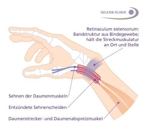 Seitliche Ansicht der rechten Hand mit Darstellung der Daumensehnen und Sehnenscheiden, die sich bei der Quervain-Krankheit aufgrund von Überlastung entzünden.