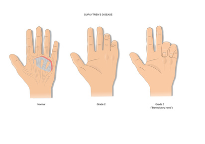 Tendovaginosis stenosans