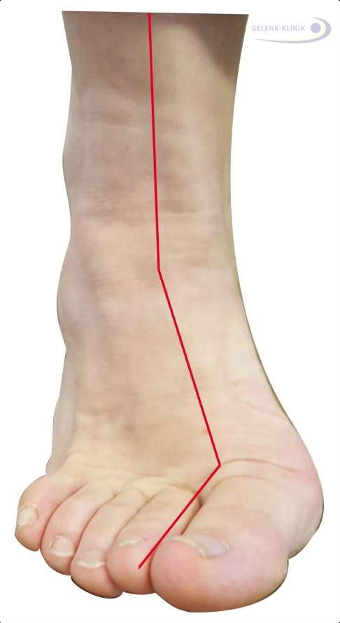 Schemabild eines Hohlfußes von vorne: Am Fuß zeigt die rote Linie eine typische Verdrehung von Rückfuß, Mittelfuß und Vorfuß bei Hohlfußfehlstellung.