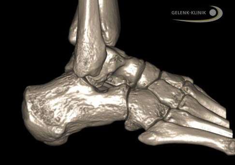 3-D-Aufnahme des Hohlfußes mit dem DVT (digitale Volumentomografie). Vor allem vor Operationen des Hohlfußes ist eine DVT-Aufnahme hilfreich, um ein vollständiges Bild der Knochen und Gelenke im Fuß zu erhalten. © gelenk-klinik.de