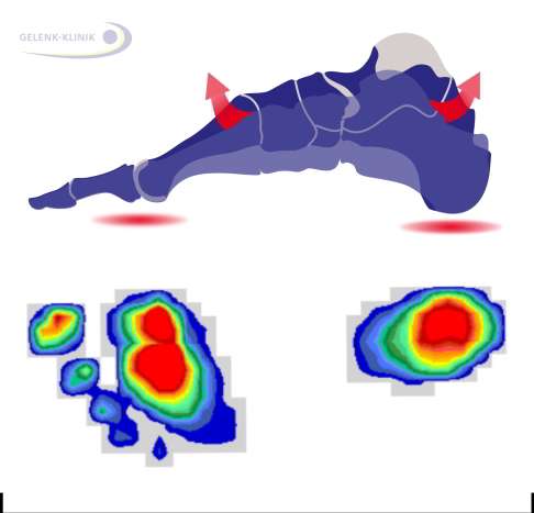 Mit Hilfe der pedobarografischen Sensorplatte kann das Fußabdruckmuster eines Hohlfußes detailliert aufgezeichnet werden. So zeigt die Pedobarografie die spezifische Funktion oder das Funktionsdefizit einzelner Sehnen und Muskeln bei der Abrollbewegung. Wie das Röntgen unter Belastung ist die Pedobarografie also eine funktionelle Untersuchung des Fußes. Typisch für den Hohlfuß ist der isolierte, aber sehr stark belastete (Rotfärbung) Druckpunkt an Ferse und Vorfuß. © gelenk-klinik