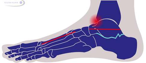 Hohlfußfehlstellung seitlich von außen gesehen: Charakteristisch für Hohlfuß ist der Winkel (rot eingezeichnet) zwischen dem Verlauf des Talus (Sprungbein) im Sprunggelenk und den Metatarsalknochen den langen Fußwurzelknochen). Dadurch entsteht eine Überlastung des Vorfußes. Zugleich wird durch den erhöhten Fußrist die vertikale - auf und ab - Beweglichkeit des oberen Sprunggelenks eingeschränkt. Es kommt vermehrt zu einem Anschlagen (Impingement) des oberen Sprunggelenks im vorderen Bereich.