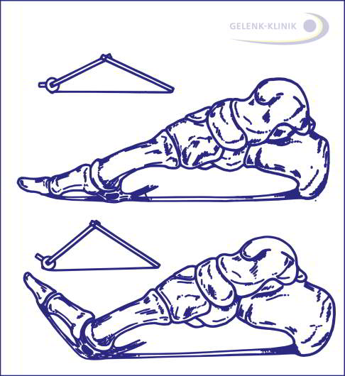 Plantarsehnenzug bei gesundem Fuß vs. Hohlfuß