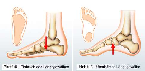 Hohlfuss Pes Excavatus Symptome Diagnose Konservative Therapie Gelenk Klinik De