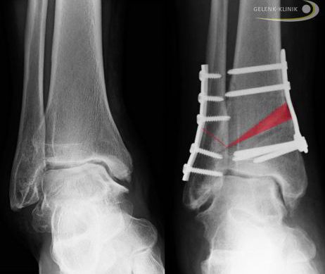 Röntgen: mit Schrauben fixiertes Sprunggelenk