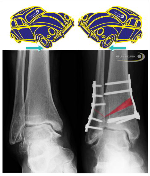 Bei einer Verdrehung des Talus (Sprungbein) im Sprunggelenk ist eine einseitige Belastung des Knorpels die Folge. Knorpelschäden sind die Folge und es entsteht Arthrose im Sprunggelenk. Durch Begradigung wird das Sprunggelenk wieder in die Spur gebracht. Die einseitige Abnutzung der Gelenke wird dadurch beendet. © gelenk-klinik.de Bei einer Verdrehung des Talus (Sprungbein) im Sprunggelenk ist eine einseitige Belastung des Knorpels die Folge. Knorpelschäden sind die Folge und es entsteht Arthrose im Sprunggelenk. Durch Begradigung wird das Sprunggelenk wieder in die Spur gebracht. Die einseitige Abnutzung der Gelenke wird dadurch beendet. © gelenk-klinik.de
