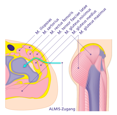 ALMIS-Zugangsweg beim minimalinvasiven Einsatz einer Hüftprothese