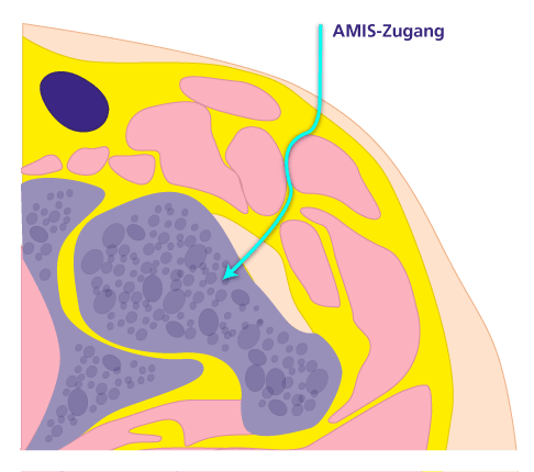 AMIS- und ALMIS-Methode: minimalinvasive OP der Hüftprothese