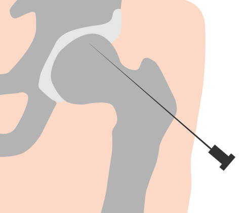 Anbohrung des Hüftkopfes bei Hüftkopfnekrose 