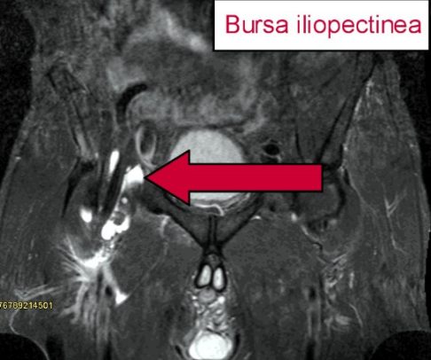 MRT-Bild einer Bursitis iliopectinea in der Leistenregion