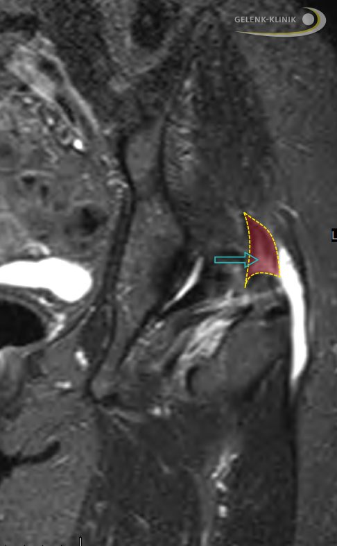 Sehnenruptur des Gluteus medius mit Schleimbeutelentzündung (Bursitis trochanterica)