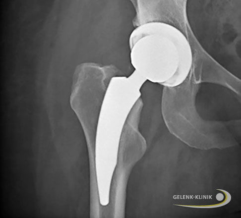 Hüft-TEP bei einseitiger Hüftarthrose wegen Hüftdysplasie.