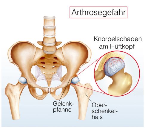 Schematisches Bild einer Hüftarthrose