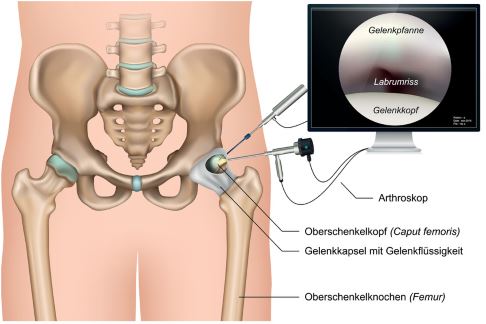 Wenn es sich bei einer Labrumläsion um einen vollständigen Abriss der Gelenklippe handelt, sollte diese in einer Arthroskopie wieder refixiert werden. © bilderzwerg, Fotolia Hüftarthroskopie bei Labrumläsion