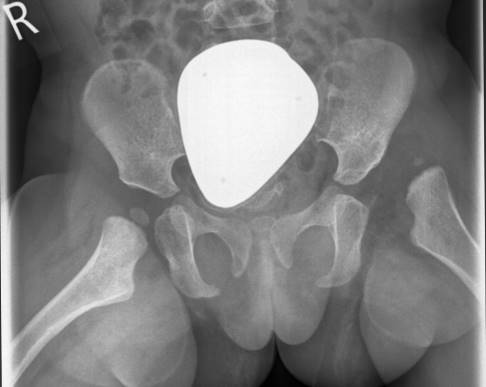 Рентген показывает слева вывих бедра с уменьшенным ядром окостенения у полуторагодовалого ребёнка. Справа показан здоровый сустав. © Gelenk-Klinik