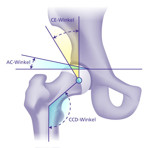 Kombinierte Darstellung der mittels Röntgenbild bestimmten Winkel zur Beurteilung einer Hüftdysplasie bei Erwachsenen