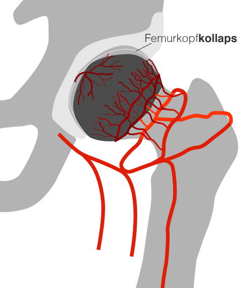 Aufgrund der Durchblutungsstörung bei Morbus Perthes wird der Hüftkopf nicht mehr ausreichend mit Nährstoffen versorgt. Es kommt zu einer Hüftkopfnekrose. Im schlimmsten Fall kann der Knochen unter der Knorpelfläche des Hüftgelenkes einbrechen. © Gelenk-Klinik Einbruch des Oberschenkelkopfes aufgrund der Durchblutungsstörung bei Morbus Perthes