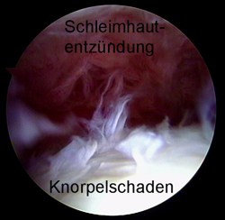 Abbildung einer entzündeten Gelenkkapsel. Stürze auf das Hüftgelenk können auch ohne Bruch Langzeitschäden verursachen und zu Arthrose führen. © Gelenk-Klinik Abbildung einer entzündeten Gelenkkapsel