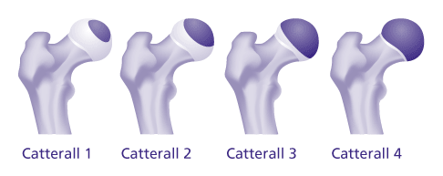 Catterall-Klassifikation zur Einschätzung des Stadiums bei Morbus Perthes