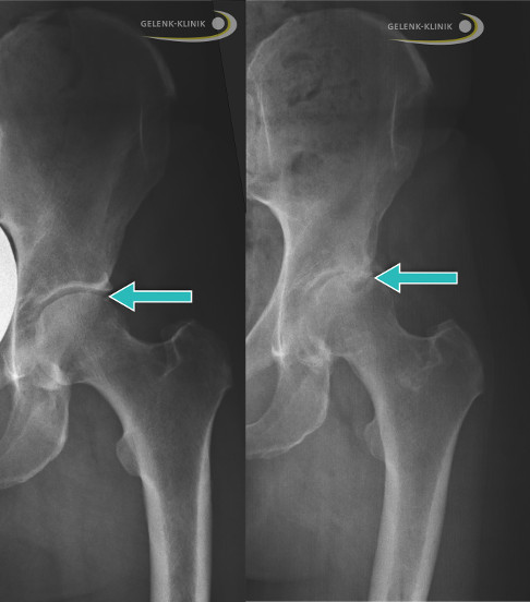 Hüftarthrose (Coxarthrose, rechtes Bild) im Vergleich zu einem nicht arthrotischen Hüftgelenk (links) im Röntgenbild