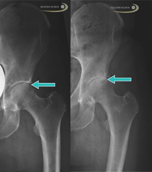 Huftarthrose Coxarthrose Gelenkerhaltende Therapie Des Huftgelenks Gelenk Klinik De