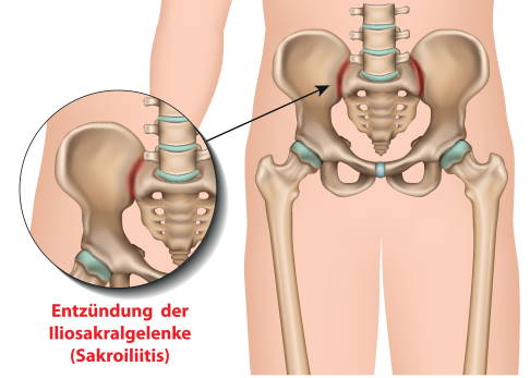 Darstellung der bei Morbus Bechterew entzündeten Kreuzbein-Darmbein-Gelenke (Iliosakralgelenke)