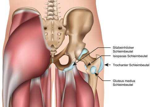 Schleimbeutelentzündung der Hüfte (Bursitis) Gelenk-Klinik.de.