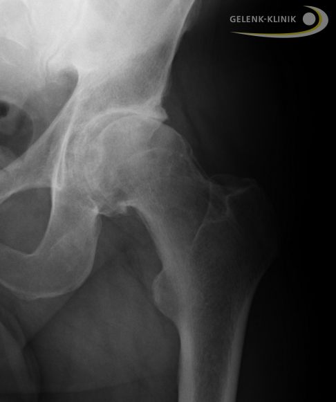 Röntgenbild einer Coxarthrose mit sichtbar verschmälertem Gelenkspalt