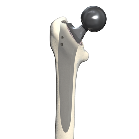 Diese Geradschaft-Hüftprothese zeigt das Problem für jüngere Patienten: Die tiefe Verankerung im Markraum des Hüftknochens ist sehr stabil. Sie erfordert aber das tiefe Ausfräsen des Femurs. Für eine spätere Revisionsoperation steht dann weniger Knochensubstanz zur Verfügung. © Smith & Nephew Die Kurzschaft-Hüft-TEP mit Keramikkopf ist eine knochensparende, abriebarme Versorgung der Hüftarthrose für jüngere Patienten.