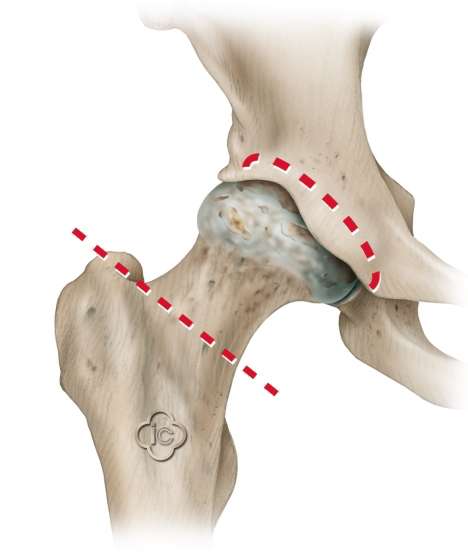 Schematische Darstellung der Implantation der Hüftendoprothese