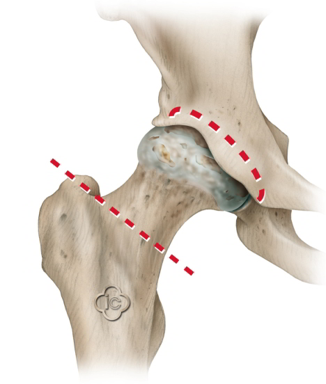 Oberschenkel mit dem gelenkbildenden Oberschenkelkopf. Die roten Linien deuten an, wo die Knochen bei der Prothesen-OP durchtrennt werden. © Implantcast Schematische Darstellung der Implantation der Hüftendoprothese