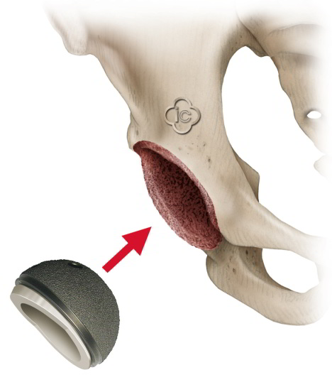 Die Gelenkpfanne (Acetabulum) wird gesäubert. Die Gelenkpfanne aus Metall wird in den Beckenknochen eingesetzt. © Implantcast Schematische Darstellung der Implantation der Hüftendoprothese