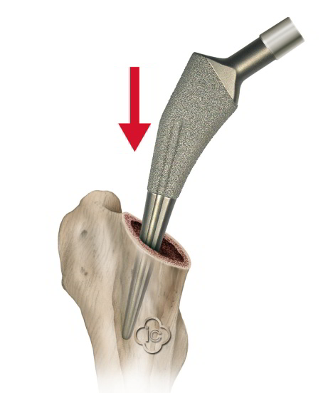 Der Markraum des Oberschenkelknochens wird ausgehöhlt. Der Schaft der Hüftprothese wird eingesetzt. © Implantcast Schematische Darstellung der Implantation der Hüftendoprothese