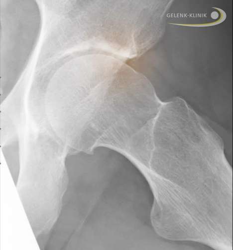Röntgenbild Cam-Impingement