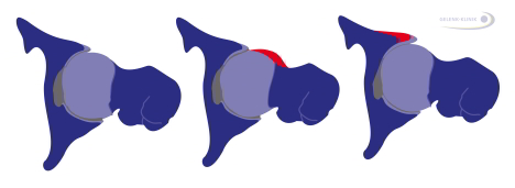 Bild: Impingement der Hüfte, Schema Cam-Impingement, Pincer-Impingement