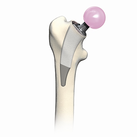 Bei jüngeren Patienten müssen wir vorausschauend einen möglichen Prothesenwechsel mit einplanen. Die knochensparende Kurzschaftprothese schont die Knochensubstanz des Oberschenkelknochens. Der Keramikkopf (rosa) ist sehr abriebfest. © Smith & Nephew Kurzschaftprothese mit Keramikkopf