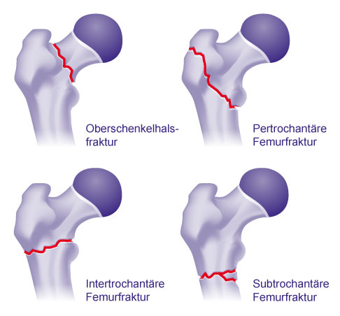 Verschiedene Femurfrakturen am proximalen Oberschenkel (Schenkelhals, pertrochantär, intertrochantär, subtrochantär)