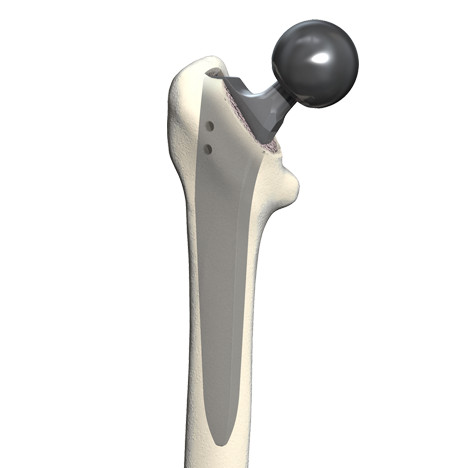 Bei älteren Patienten mit sehr guter Knochendichte verwenden wir die erprobte einwachsende, zementfreie Geradschaftprothese, die tief im Markraum des Oberschenkelknochens verankert wird. Um den Abrieb zu minimieren, bevorzugen wir die keramikbeschichtete Oxinium-Hüftprothese. Ihre Oberfläche ist viel glatter als die einer konventionellen Titanprothese.