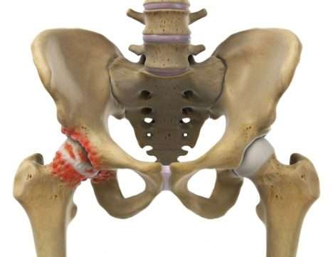 При сильном износе хрящевой поверхности, в тазобедренном суставе образуются костные наросты, вызывающие его неподвижность. Остеофиты появляются на головке бедренной кости и на вертлужной впадине (красный цвет). Артроз прогрессирует. На ранней стадии проводится артроскопия. © Istockphoto