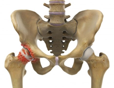 Je stärker die Knorpelfläche abgenutzt ist, um so deutlicher wird die Tendenz des Gelenks, sich durch die Bildung von Knochenanbauten selbst zu versteifen. Es bilden sich Osteophyten auf dem Oberschenkelkopf, aber auch in der Hüftgelenkspfanne. Diese Knochenabauten führen zu einer weiteren Absenkung der Gleitfähigkeit der Gleitflächen im Hüftgelenk: Knorpelabbau und Arthrose verstärken sich. Nur im Frühstadium kann es helfen, diese Osteophyten am Oberschenkelkopf operativ - durch eine Hüftarthroskopie - abzutragen. © Istockphoto Hüftarthrose mit Osteophyten (Knochensporne)