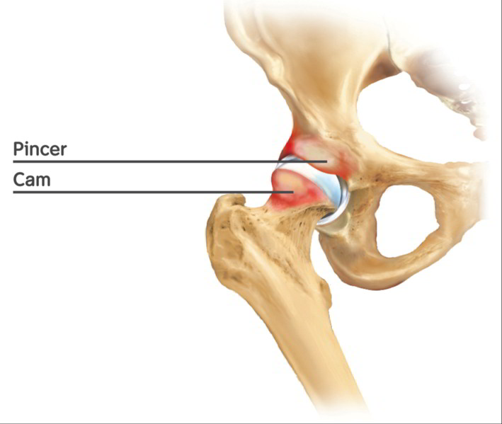 Bild: Impingement der Hüfte, Schema Cam-Impingement, Pincer-Impingement