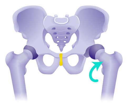 Schematische Darstellung einer Hüftluxation