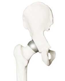 Die Hüft-Teilprothese (McMinn-Prothese) ersetzt die geschädigte Gelenkfläche des Hüftkopfes.
