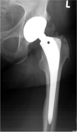 Röntgenkontrolle einer Hüftprothese: Hier im Röntgenbild sieht man eine konventionelle Geradschaftprothese. Der Prothesesenschaft ist tief im Markraum des Oberschenkels verankert. Die Gelenkspfanne ist im Beckenknochen verankert. Röntgenkontolle einer Hüftprothese