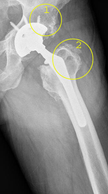 Ausgangslage: Septische Osteolyse einer Hüftprothese: Gelb markiert sind die im Röntgenbild deutlich sichtbaren demineralisierten Bereiche: 1. Beckenknochen in der Umgebung der Hüftpfanne (Acetabulum): 2. Oberschenkelknochen (Femur). Diese geschwächten Bereiche sind nicht mehr in der Lage, den Prothesenschaft alleine angemessen zu befestigen. Die Planung der Hüftprothesen-Revision muss das berücksichtigen und die Befestigung durch Ersatzmaterialien oder andere Befestigungsstrategien ergänzen. © Dr. Martin Rinio Septische Osteolyse einer Hüftprothese