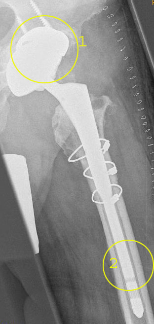 Gleicher Patient: Prothesenrevision nach septischer Osteolyse einer Hüftprothese: 1. Die demineralisierten Bereiche des Knochens im Becken wurden durch gezielten Aufbau mit Knochenersatz verstärkt. 2. Der durch Infekt geschwächte Oberschenkelknochen wird durch eine tiefe Verankerung der Prothese im Röhrenknochen entlastet. Die kreisförmigen Drähte (Cerclage), die den Femur umgeben, stabilisieren den Oberschenkelknochen, der zur Entfernung des infizierten Prothesenschaftes der Länge nach aufgespalten und aufgeklappt wurde (transfemoraler Zugang). © Dr. Martin Rinio Septische Osteolyse einer Hüftprothese: Prothesenrevision