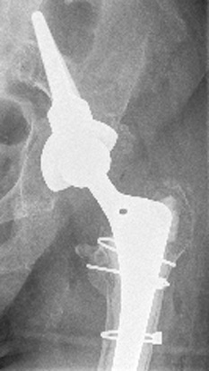 Hochbetagte Patientin nach Sturz auf die linke Hüfte. Acetabulumfraktur mit Lockerung der Hüftpfanne (Acetabulum) durch Acetabulumfraktur. Wechsel der wird durch eine Sockelpfanne mit einem im dorsalen Beckenknochen verankerten Aufsatz ausgeglichen. Er füllt die zur Verfügung stehende Hüftpfannenform optimal aus. Es erfolgt eine zusätzliche Befestigung durch Knochenschrauben, die einer Lockerung vorbeugen. © Dr. Martin Rinio Befestigung der Hüftpfanne mit Sockelpfanne